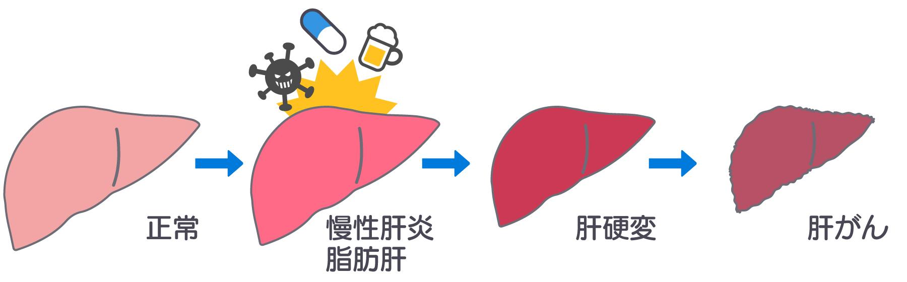 正常な肝臓ががんになるまでの経緯